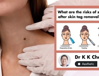 3 Ways to safely remove skin tags at NUU Aesthetic Clinic